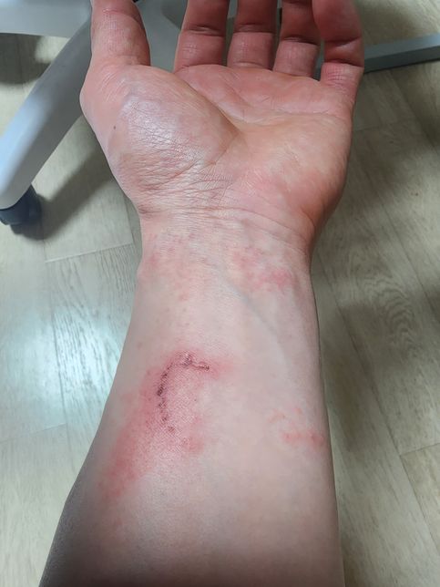 옻 알레르기 어떤 연고를 발라야할까요?의 0번 째 이미지