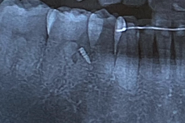 교정치료 이후 스크류(교정 보조장치)가 부러진 채로 그대로 박혀있다고 합니다 보상 받을 수 있을까요?의 0번 째 이미지