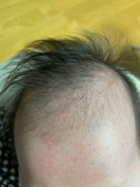 신생아 얼굴에 붉은반잠이 났어요의 0번 째 이미지