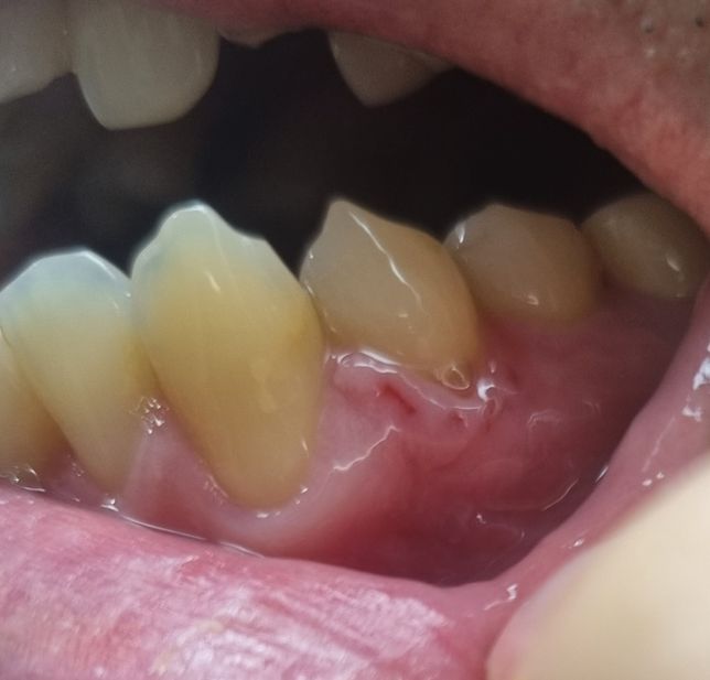 임플란트 본뜨러갔다가 잇몸에 상처가 났는데 보상 어떻게 받나요?의 0번 째 이미지