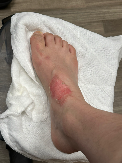 대학교 3학년에 재학 중인 딸이 카페 알바 중 화상?의 0번 째 이미지