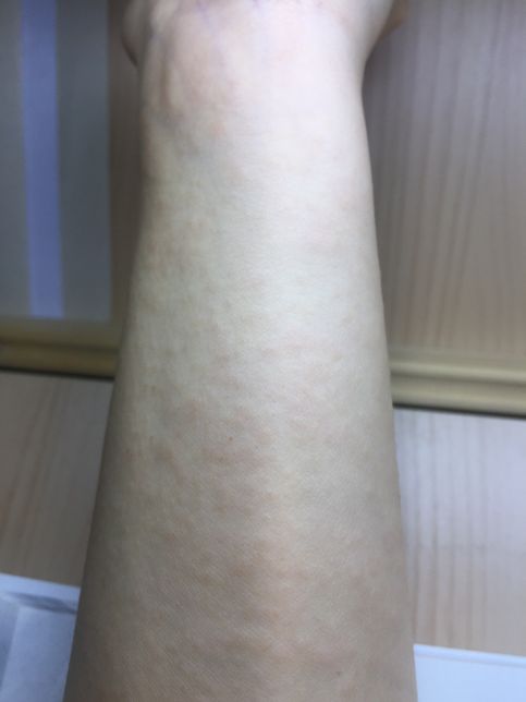 항생제나 녹내장 약이 가려움증을 <mark>유발</mark>하기도 하나요??의 0번 째 이미지