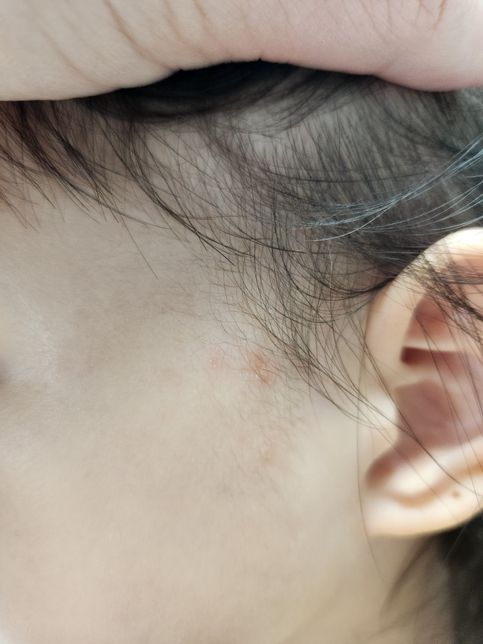 아이 왼쪽 뺨에 생긴 피부 질환이 계속 재발 되는 것 같은데, 연고 추천 부탁드립니다.의 0번 째 이미지