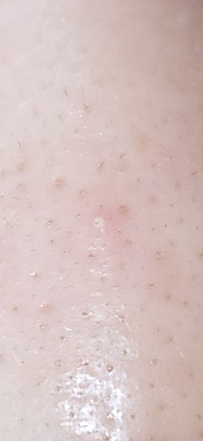 배아로반1일 여드름 처방 약1일 이렇게 하루씩 2일 발랐는데의 0번 째 이미지