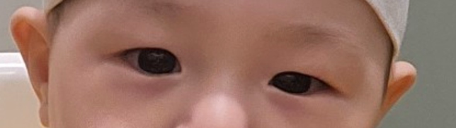 9개월 아기 눈 안검하수 일까요?의 0번 째 이미지