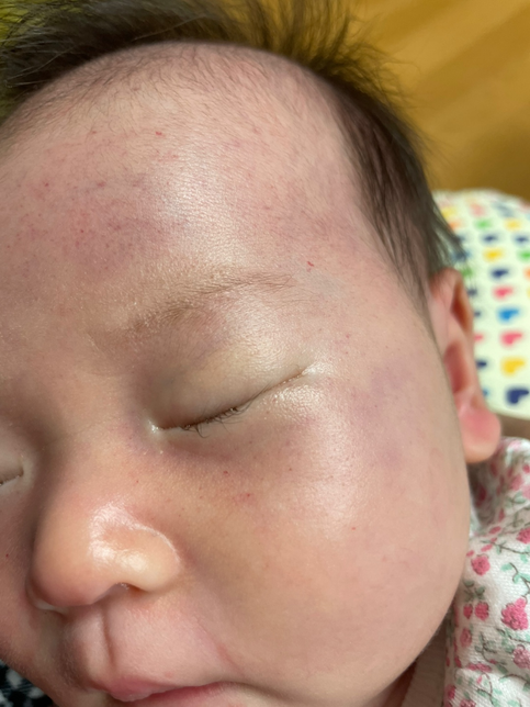 신생아 얼굴에 붉은반잠이 났어요의 1번 째 이미지