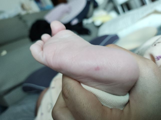 갑자기생겼어요 발바닥 붉은 점 뭘까요 ?의 0번 째 이미지
