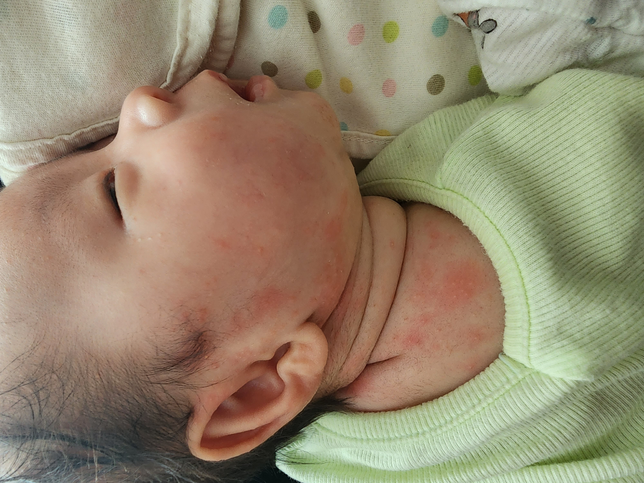 아기 목과 얼굴 쪽에 번지는 것이 태열일까요? 땀띠인가요? 아님 다른 병일까요?의 0번 째 이미지