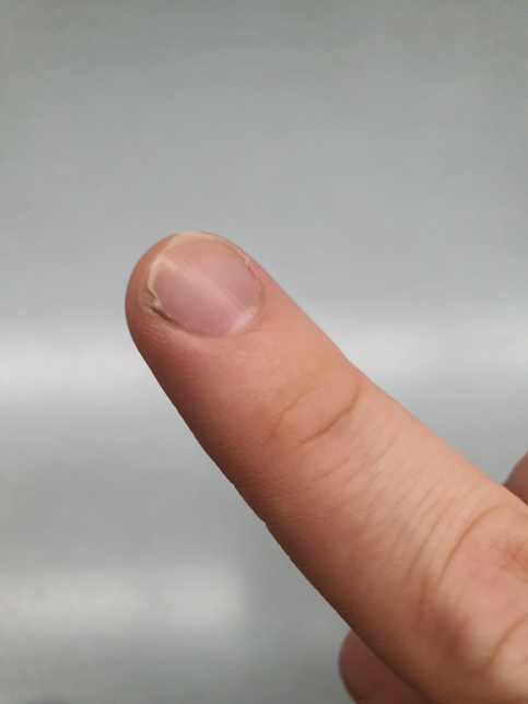 손톱이 2주에 한번꼴로 자주 끊어지는 데 왜 그러는 거죠 영양불충분이라서 그런건지 알고 싶어요의 0번 째 이미지