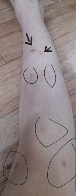 4달 전부터 다리에 검은 점 7곳 남의 0번 째 이미지