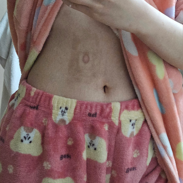 이 흉터 지우는 방법이 뭔가요의 0번 째 이미지