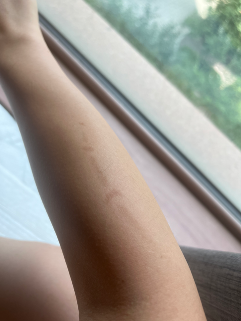 화상흉터치료 흥국화재에서 미용 목적이라고 보상 안해준다는데 개인부단 해야할까요?의 0번 째 이미지