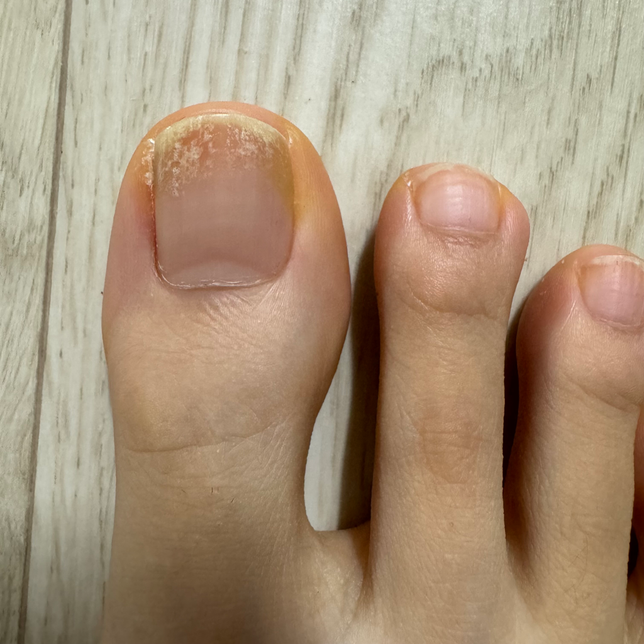 여자 엄지발톱 무좀 초기증상인가요?의 0번 째 이미지