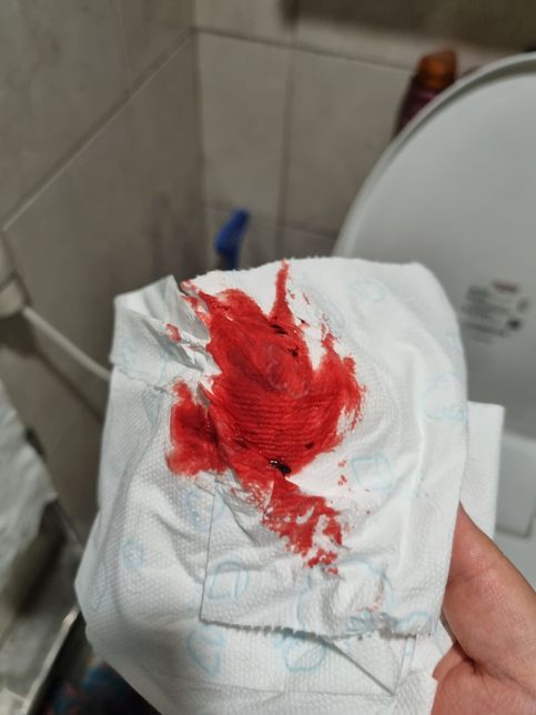 선생님들 생리일까요 착상혈일까요?의 1번 째 이미지