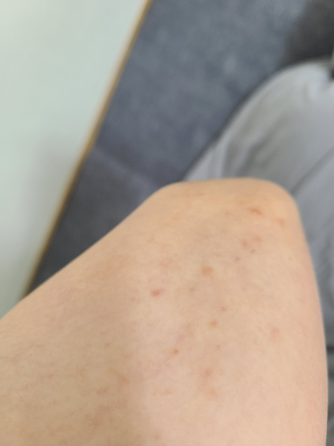 팔꿈치에 여드름 같은게 있는데 효과 좋은 연고 있나요?의 0번 째 이미지