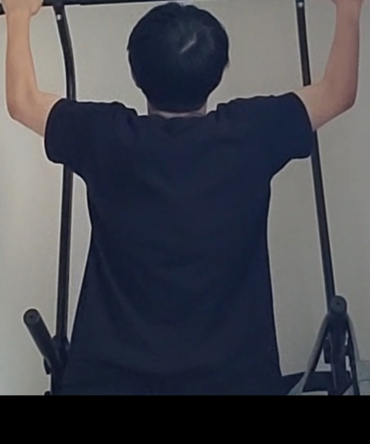 이정도면 정수리 탈모일까요?? 소견 한말씀 부탁드립니다의 1번 째 이미지