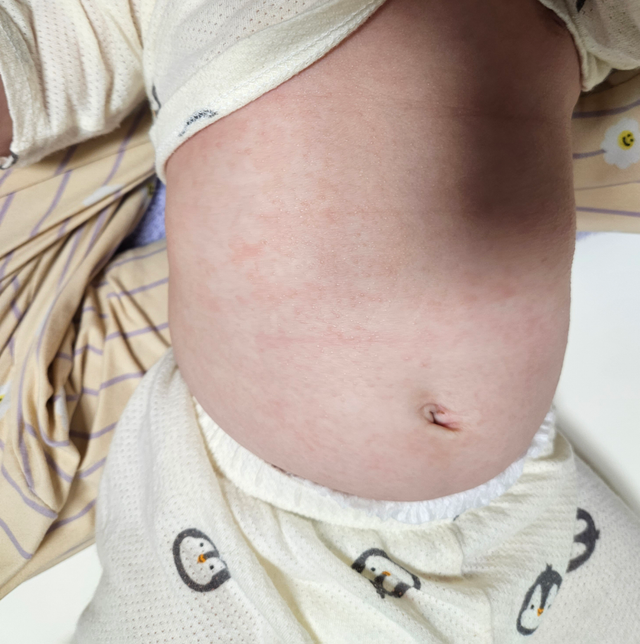 아기 배쪽 빨갛게 오돌도톨 올라왔는데 더워서 일까요?의 0번 째 이미지