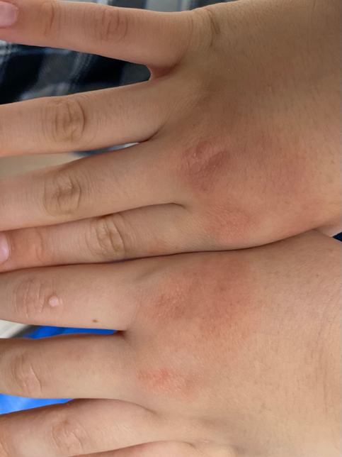 아이 손등이 빨개졌는데 왜그럴까요의 0번 째 이미지