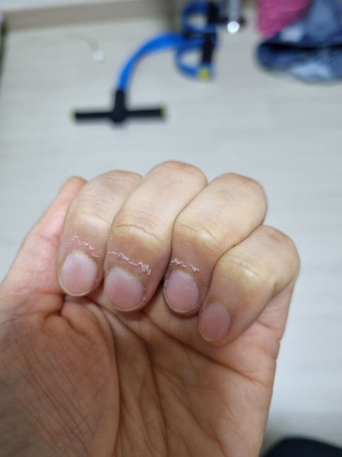 겨울되면 손톱밑에 거스름?이 왜이럴까요?의 1번 째 이미지