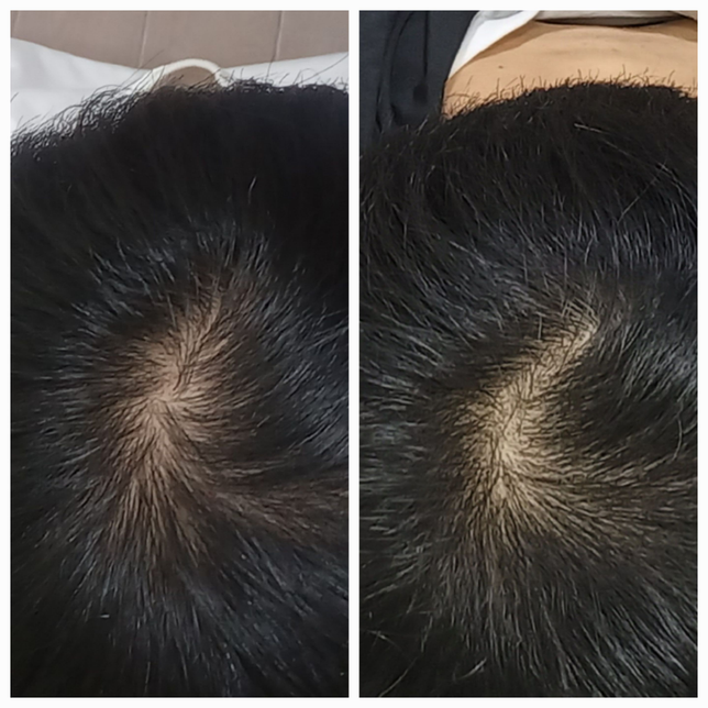 19살 남자 정수리 탈모 징조인가요?의 1번 째 이미지