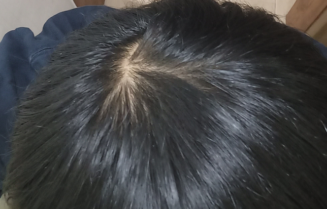 19살 남자 이정도면 정수리 탈모인가요??의 3번 째 이미지