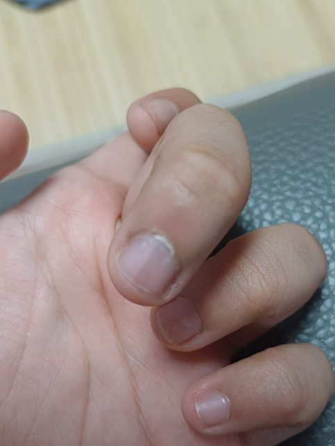 손가락의 검은 선은 뭔가요? 흑색종인가요?의 0번 째 이미지