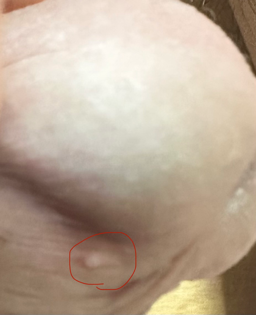 성기 부분 뒤쪽에 뾰루지 같은게 있습니다의 0번 째 이미지