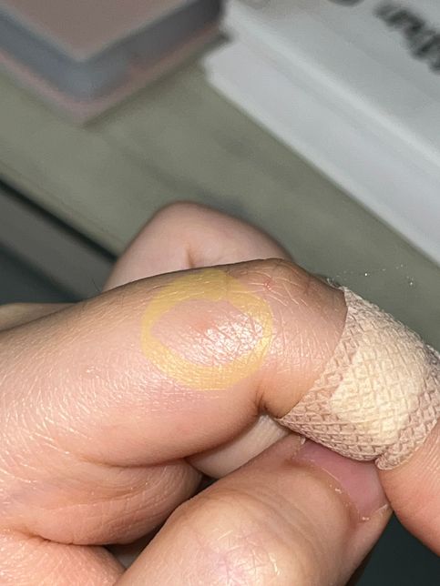 손가락에 갑자기 가려운 수포가 올라왔는데 사마귀인가요??의 0번 째 이미지