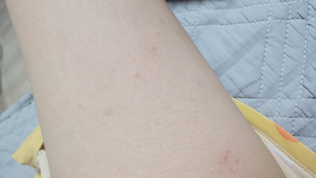 피부에 모기물린자국처럼 이상한게났어요 모기는아니에요의 1번 째 이미지