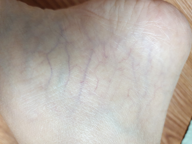 발목부분의 혈관이 너무 드러나있는데 괜찮나요?의 0번 째 이미지