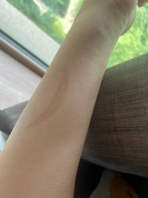 화상흉터치료 흥국화재에서 미용 목적이라고 보상 안해준다는데 개인부단 해야할까요?의 1번 째 이미지