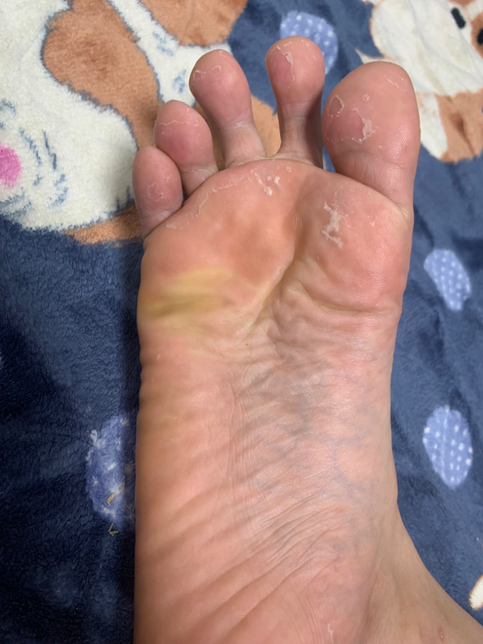 습진인지 무좀인지 알수있을까요?의 0번 째 이미지