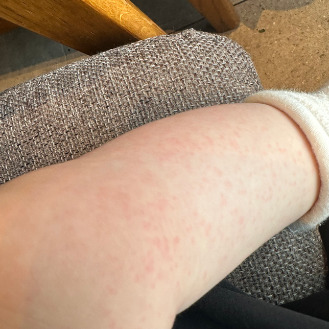 8개월아이입니다 갑자기피부가이러는데 수족구일까요?의 0번 째 이미지