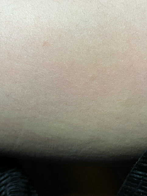 종아리 튼살 생기는 이유가 뭘까요의 0번 째 이미지