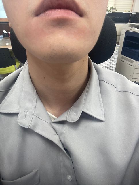 입주변 붉은기 홍조.. 병명이 궁금합니다.의 0번 째 이미지