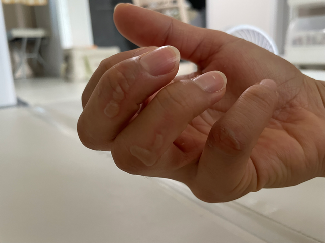 탕후루 만들다가 화상입었는데 심한건가요?의 0번 째 이미지