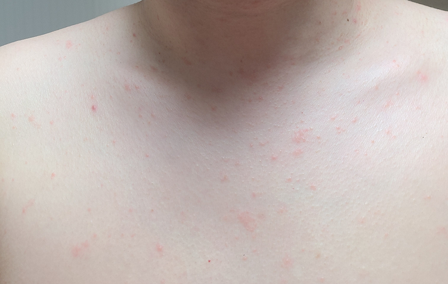 땀띠 때문에 리도맥스0.15%발랐는데 빨게졌어요의 0번 째 이미지