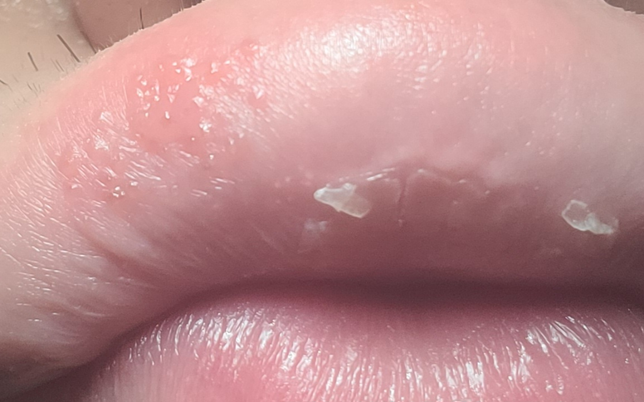 입술에 물집? 포진?같은게 생겼는데 어떤연고 발라야하나요?의 0번 째 이미지