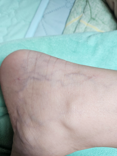 임신 24주차 하지정맥류 증상이 나타나는데 문제 없을까요의 0번 째 이미지