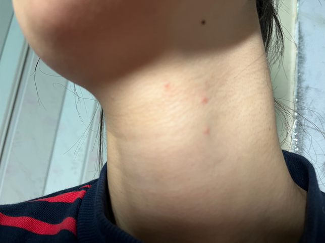 자고 일어났더니 목에 물린 상처가 궁금해요의 0번 째 이미지