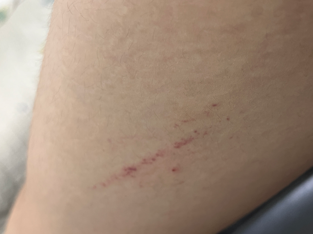 처방받은 약중에 알러지반응이 부작용인 약이 있는데 이것이 알러지 반응인가요?의 0번 째 이미지