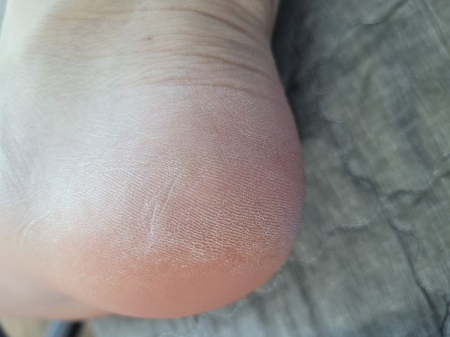 발바닥 각질 어떻게 해야할까요?의 0번 째 이미지