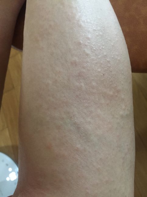 항생제나 녹내장 약이 가려움증을 <mark>유발</mark>하기도 하나요??의 1번 째 이미지