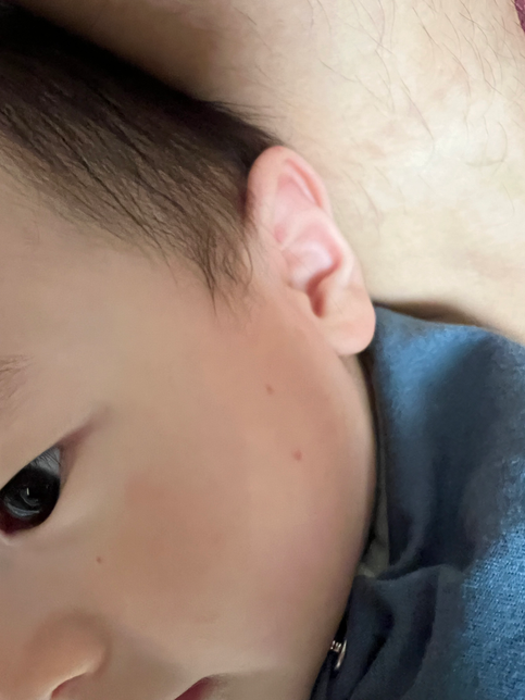 돌아기 빨간 반점 뭘까요? 얼굴쪽에만 조금 납니다의 0번 째 이미지