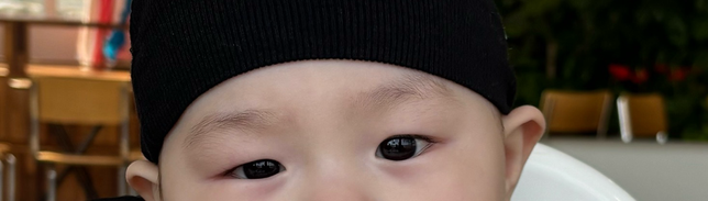 9개월 아기 눈 안검하수 일까요?의 2번 째 이미지