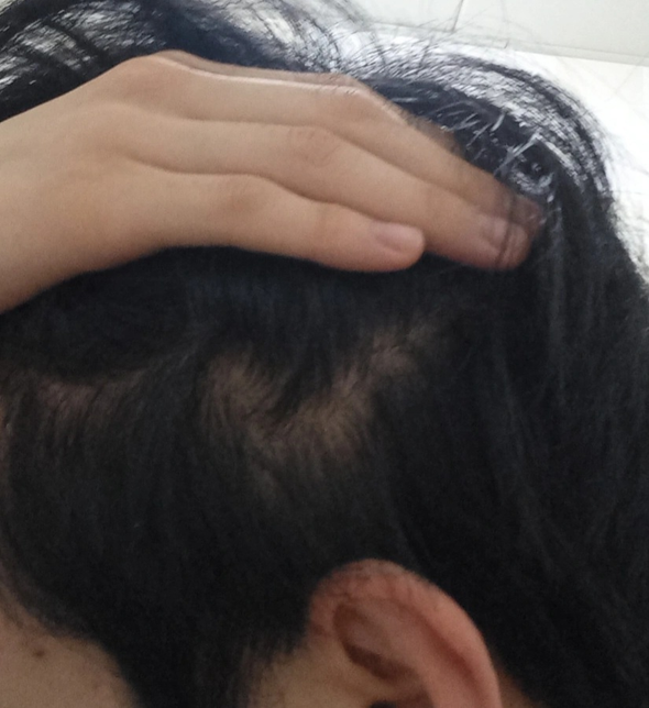 19살 옆머리 탈모 인가요??의 2번 째 이미지