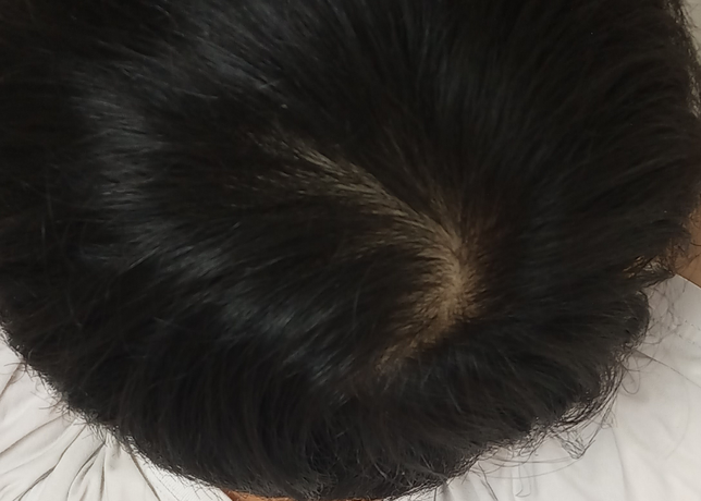 19살 남자 정수리 탈모 징조인가요?의 0번 째 이미지