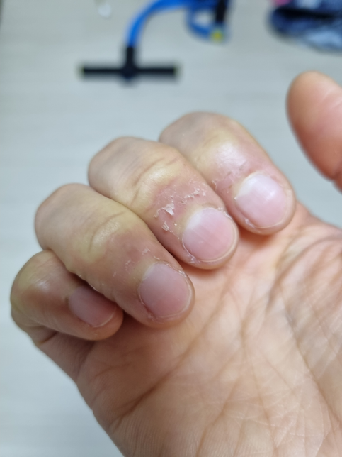 겨울되면 손톱밑에 거스름?이 왜이럴까요?의 0번 째 이미지