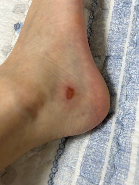 구두신다가 상처가 났는데 어떤 밴드를 붙여야 할까요?의 0번 째 이미지