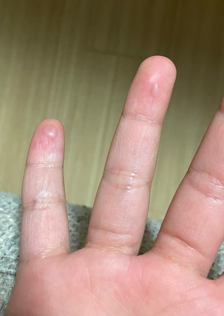 아이 손에 수포가 있는데 뭔지 모르겠어요의 0번 째 이미지